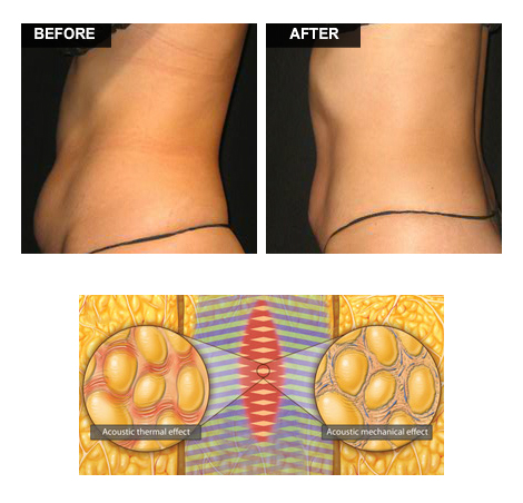 изгаряне на мазнини Liporedux San